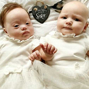 Англичанка родила двойню, у одной из девочек - синдром Дауна